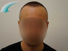 After Hair Transplant