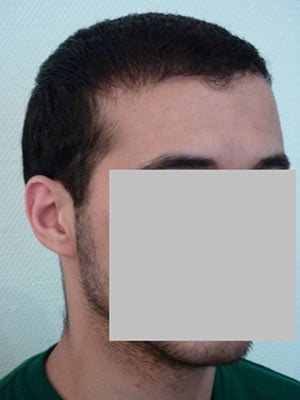 Result after 9months transplant hair