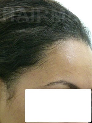 Result transplant hair