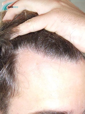After 2000 transplant hair Dr Beyhan