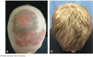 Amazing discovery! FDA-approved arthritis drug, tofacitinib, grows a full head of hair on a patient suffering from Alopecia Universalis during a study at Yale.