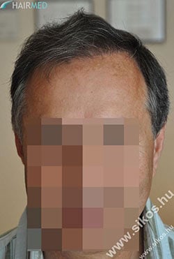 Transplant hair Dr Sikos