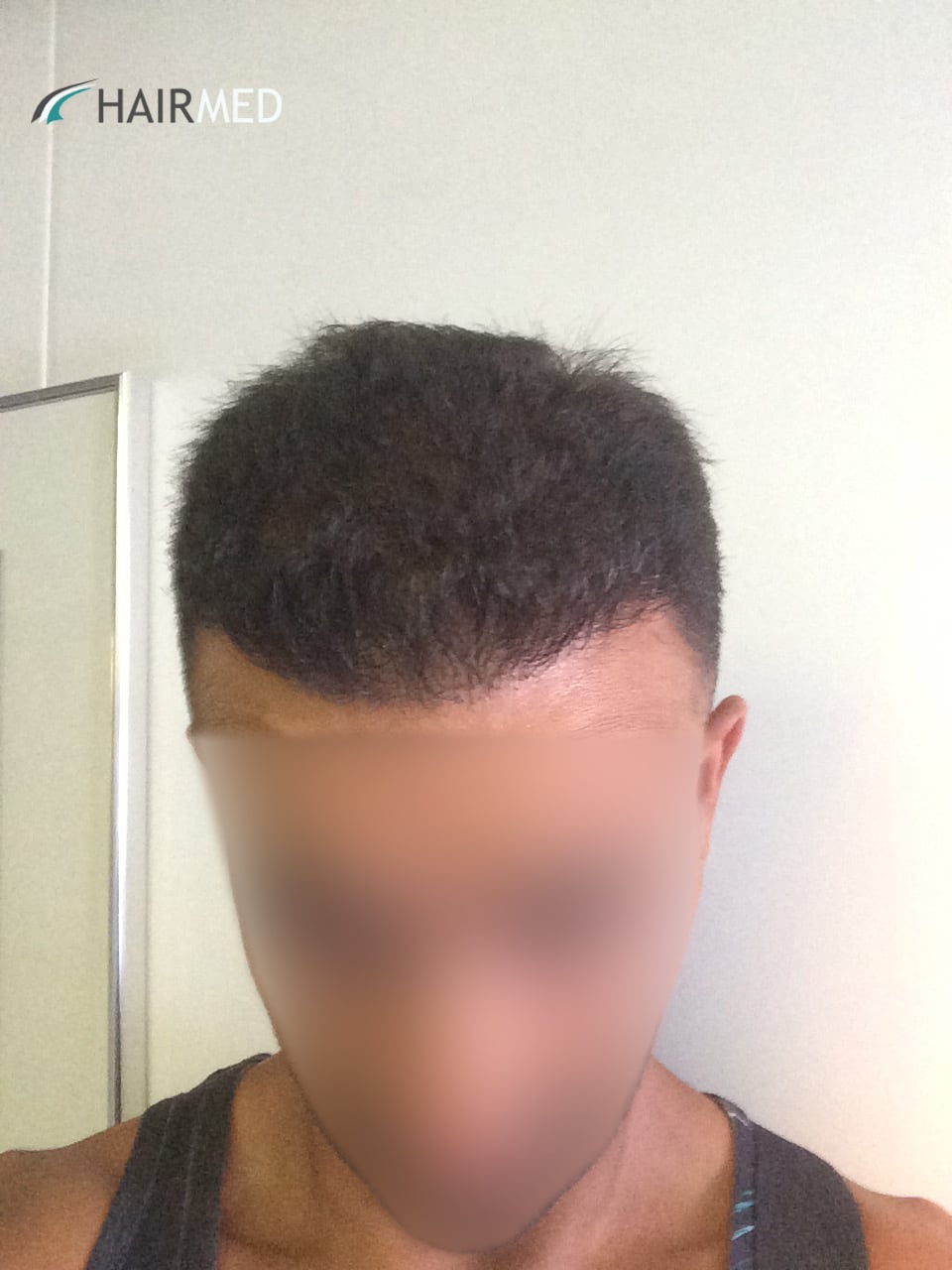 Post op 6 months Hacer Yuce