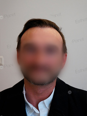 result transplant hair in Turkey
