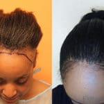 Result afro hair transplant