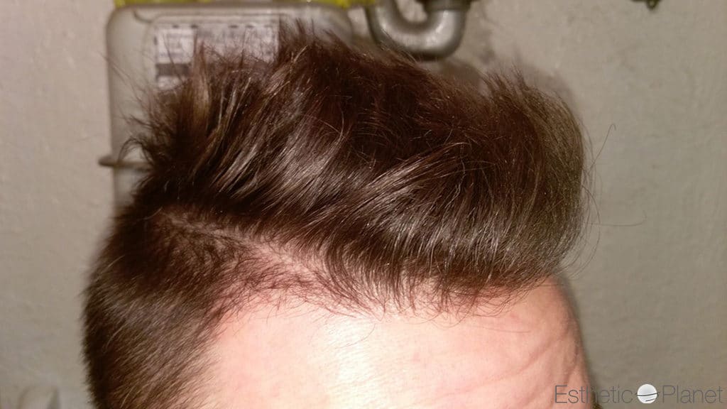 After hairtransplant Dr Ouriaghli