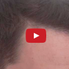 Video of 1500 grafts in Brussels